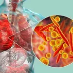 Rana dijagnoza raka pluća kroz skrining program