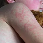 Ošpice v otroški dobi: odlična zaščita pred rakavimi obolenji