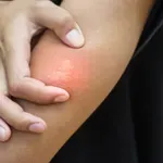 Zakaj nas pik čebele boli še dva dni, pik ose pa hitro popusti?