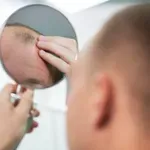 Prihaja serum, ki bo rešil plešavost v 20 dneh?