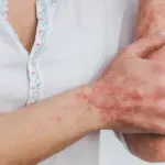 Как да се храните, ако имате псориазис?