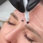 Resnica o botoksu, ki jo moraš poznati, preden bo prepozno