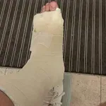 Znani Slovenec pristal v mavcu. Kaj bo sedaj?