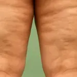 Naj vas ne bo strah zaradi celulita stopiti na plažo