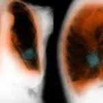 Ta bolezen je neozdravljiva, kako vem, da jo imam