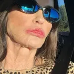 V šovu je nekoč ena najlepših zvezdnic na planetu utrpela trajne poškodbe obraza