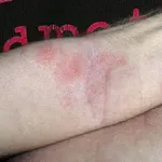 Opazili so jih tudi v Sloveniji, povzročajo hude bolečine